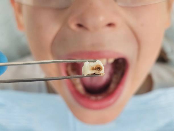 Best Emergency Dental Extractions in Carrboro, NC